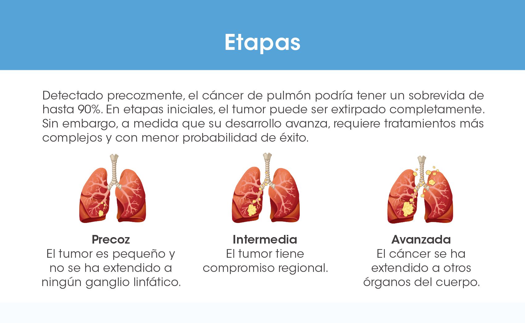 etapa 2 del cancer de pulmon